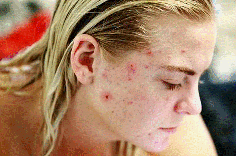 CBD May Reduce Acne